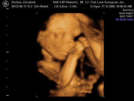 my babys ultra sound at 5 months