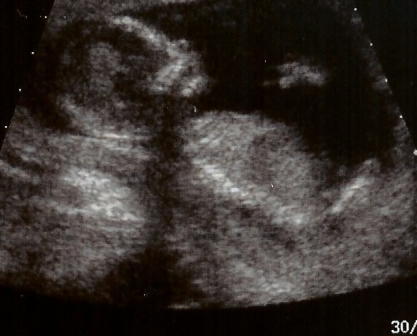 12 week ultrasound