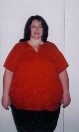 V before gastric bypass 11-16-04