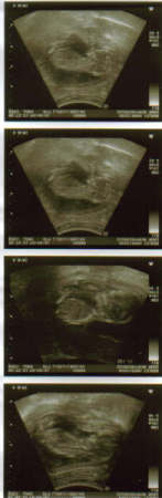 Horrible Quality Ultrasound Pics