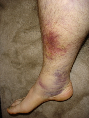 bruised-leg