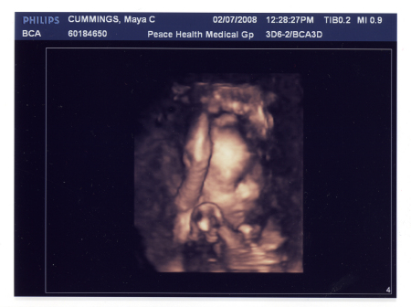 3-D Ultrasound at 26 weeks.