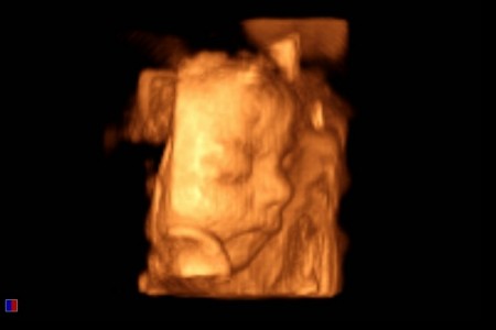 Hailey seen with a 4D Ultrasound