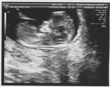 Ultrasound of our baby at 11 weeks, 5 days of pregnancy!