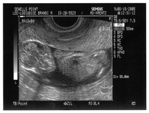 Our unborn baby 3mth