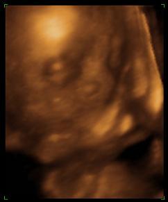 My twin granddaughter 27 weeks