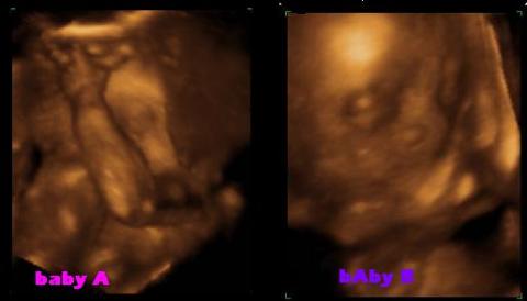 My Grand-daughters 27 weeks