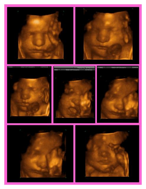 30 week ultrasound