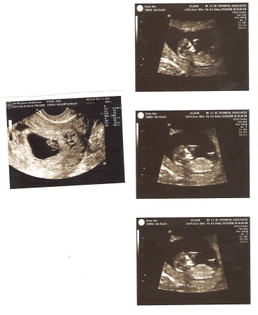 Ultrasound at 8 weeks Tyler Matthew Itzoe