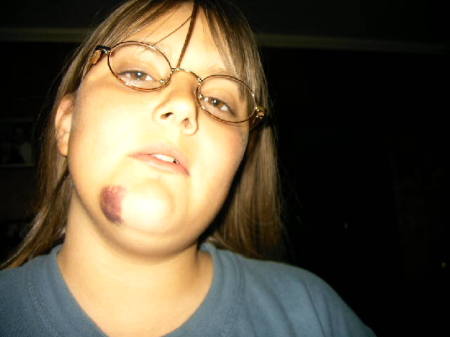 Jaycee's first softball wound of 08