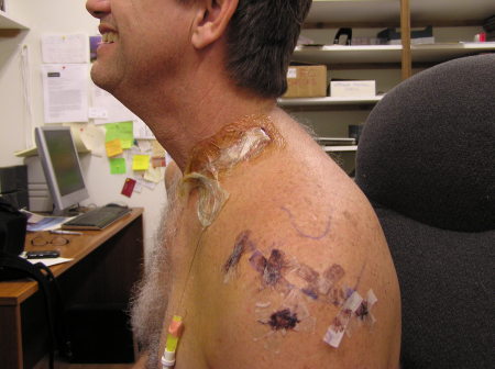 Rotator cuff surgery, 12/5/08