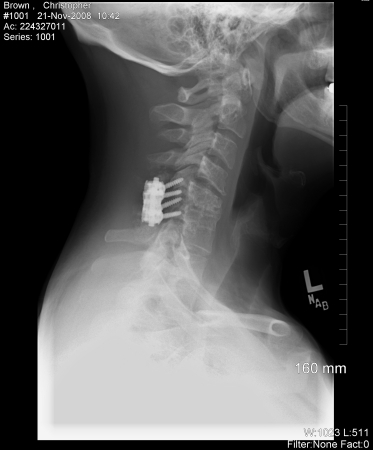 my lastest neck fusion