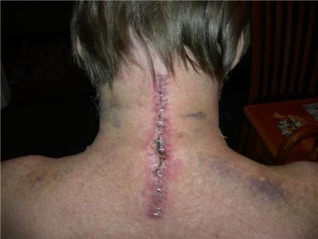 Neck Surgery '09