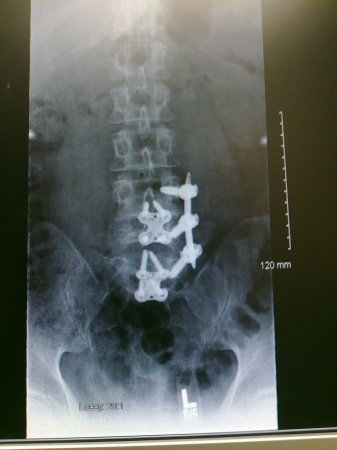 my titanium spine, see how skinny i am!