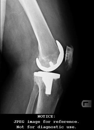 LATERAL POST OP XRAYS