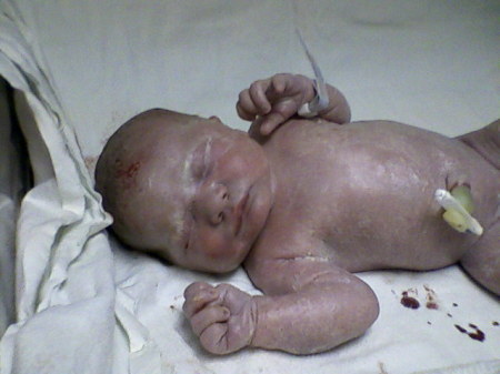 Gracelyn just after she was born