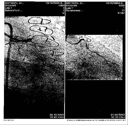 Mike's Heart before and after a Stent