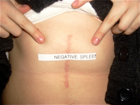 Negative Spleen.