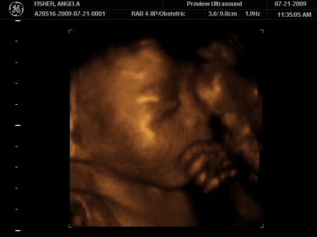 Braxtin's 3D Ultrasound - 28 weeks gestation
