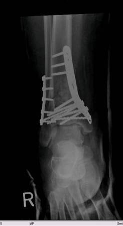 My broken leg