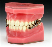types-of-braces-6