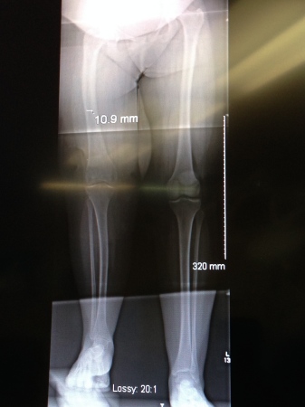 X-Ray image for femur correction case Shriners