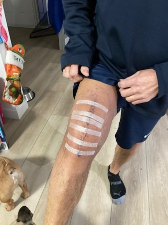 Total knee replacement 2022, scars to prove it