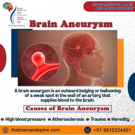 Brain Aneurysm 