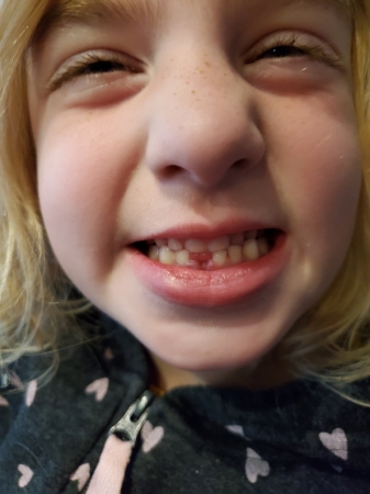 First tooth gone