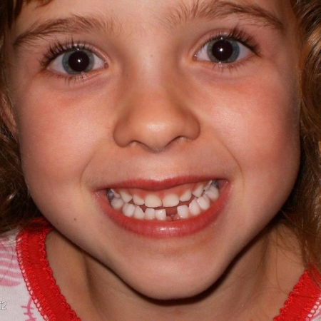 Elizabethe's 1st lost tooth