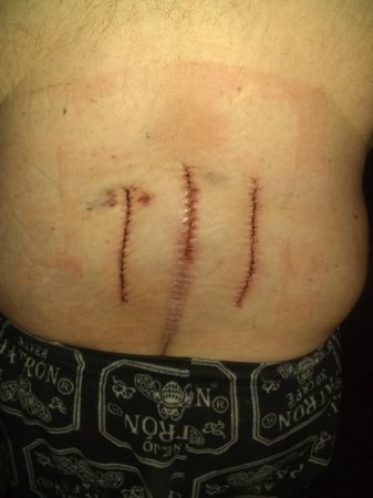 My back 2 surgeries in 