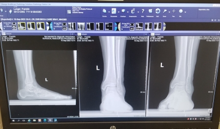 Ankle no metal, next hardware remove form knee