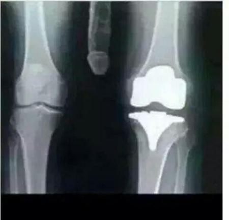 my x ray from broken knee