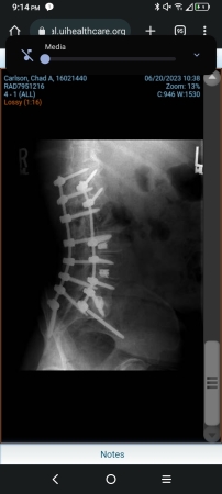 My back fusion side view 